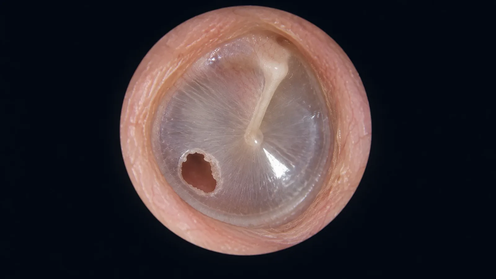 Otoscope view of an eardrum with a small hole (perforation)