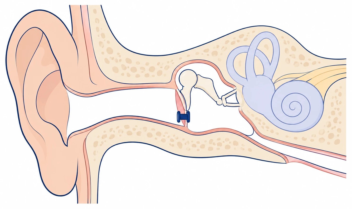 Cross-section of a child's ear: the ear canal leads to the eardrum, and a tiny tube passes through the lower part of the eardrum into the air-filled middle ear, which holds the three small hearing bones. The Eustachian tube runs from the middle ear toward the back of the nose.