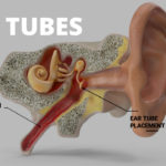 Ear Tubes From Capital ENT And Sinus Center In Austin, TX